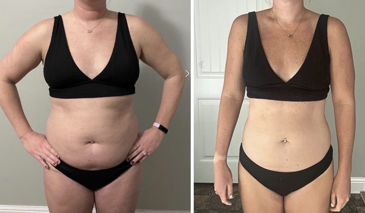 Forever Rising client before and after photo showing a flatter midsection